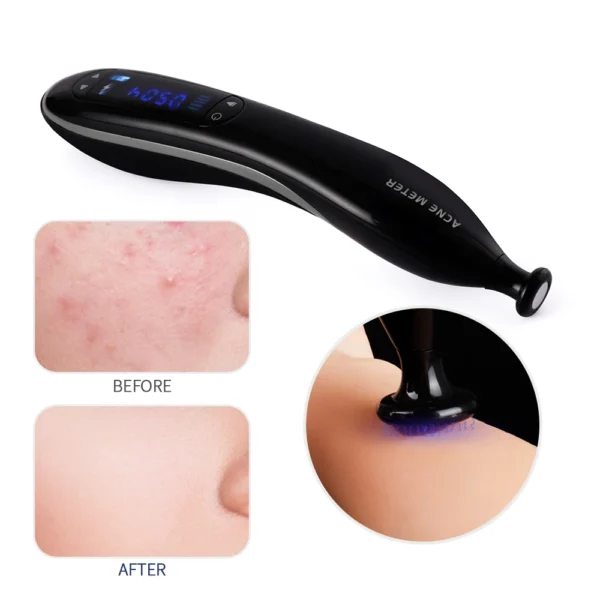 Blue Light Ozone Acne Treatment Machine Cold Plasma Skin Rejuvenation Plasma Pen for Acne Scar Wrinkle Removal jato de plasma