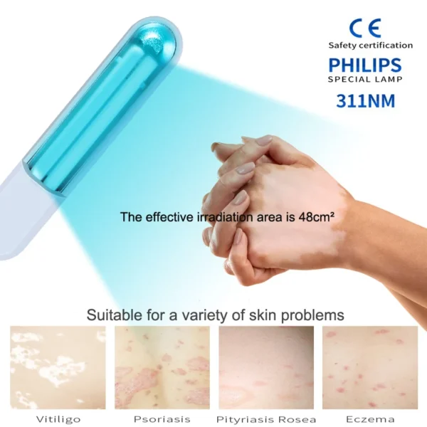 Portable UV Phototherapy: Targeted Relief for Vitiligo, Psoriasis, Eczema