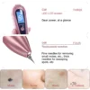 Advanced Microcomputer Control Skin Tag & Spot Remover: Clearer Skin, Pain-Free - Image 3
