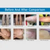 Portable UV Phototherapy: Targeted Relief for Vitiligo, Psoriasis, Eczema - Image 4